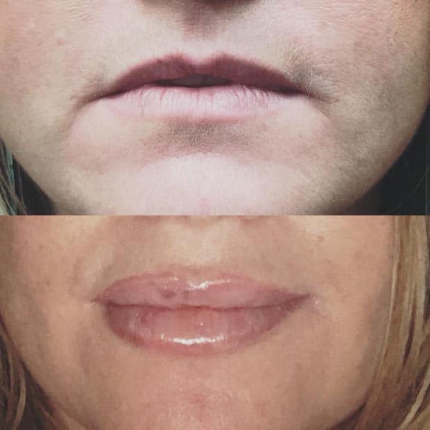 Before and after of Injectable Services at Be You Medical Spa.