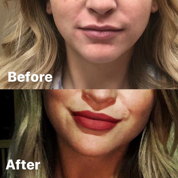 Before and after of Injectable Services at Be You Medical Spa.