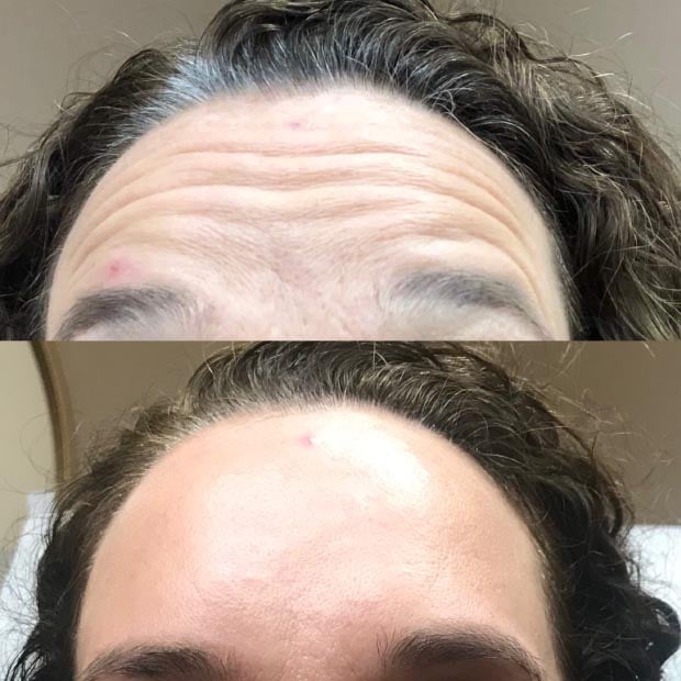 Before and after of Botox Injections at Be You Medical Spa.
