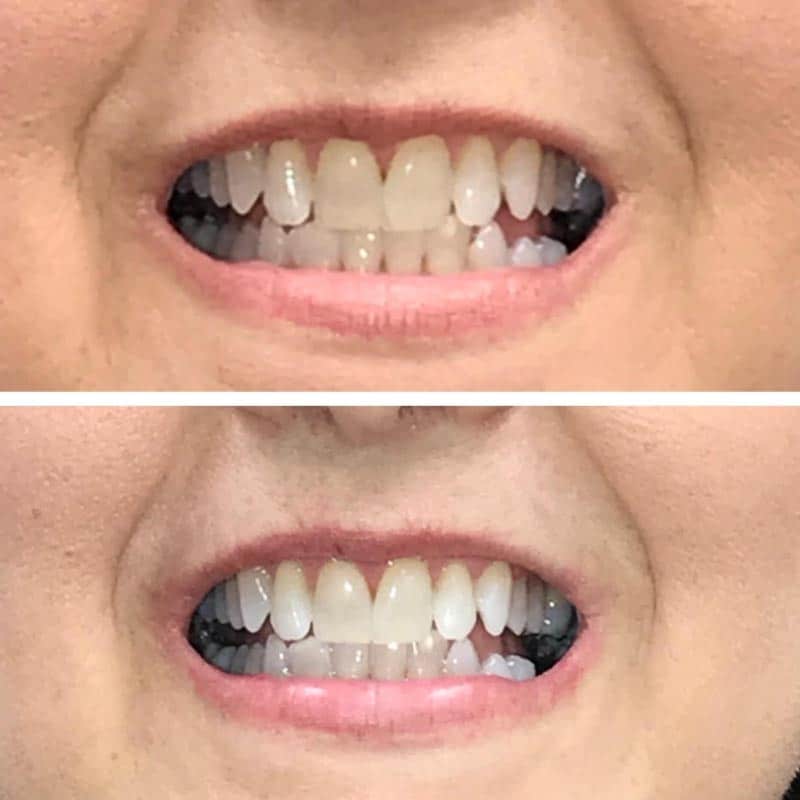 Before and after of teeth whitening at Be You Medical Spa.